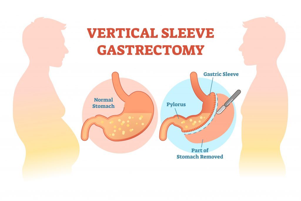 Lose Weight Fast With Gastric Sleeve Surgery