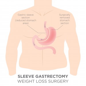 gastric sleeve surgery birmingham