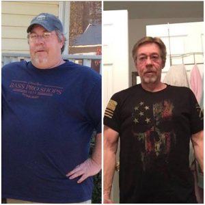 before and after weight loss surgery