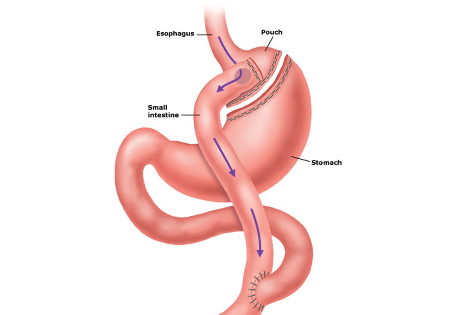 Weight Loss Surgery Near Mobile Al Bariatric Surgery