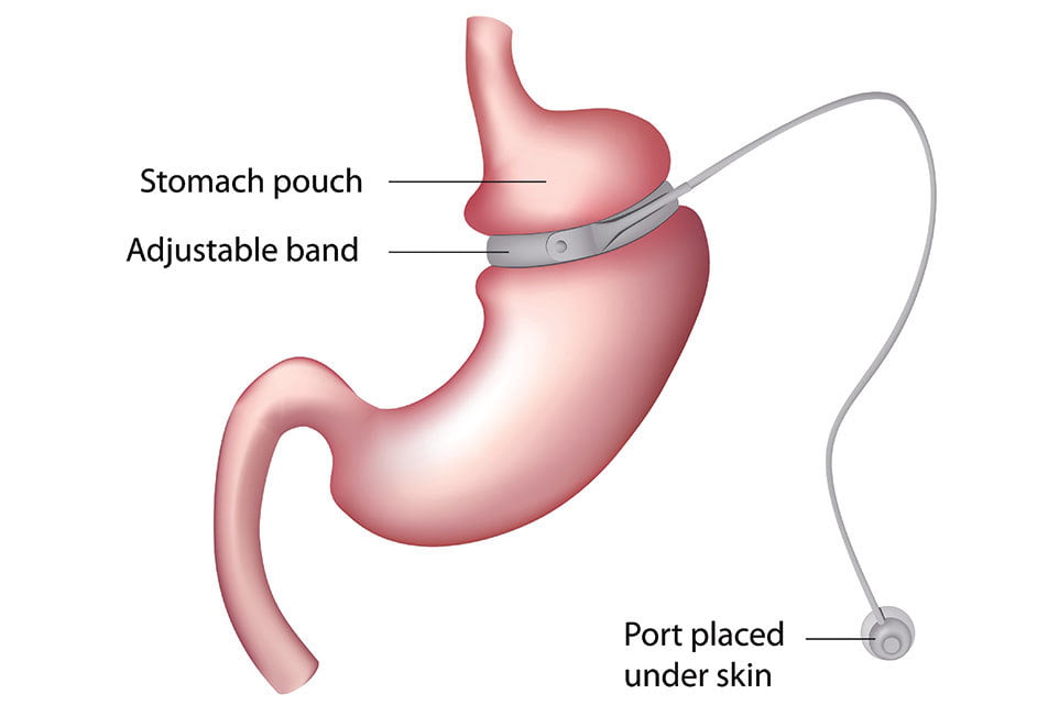 Lap-Band Weight Loss Surgery at Birmingham Minimally Invasive