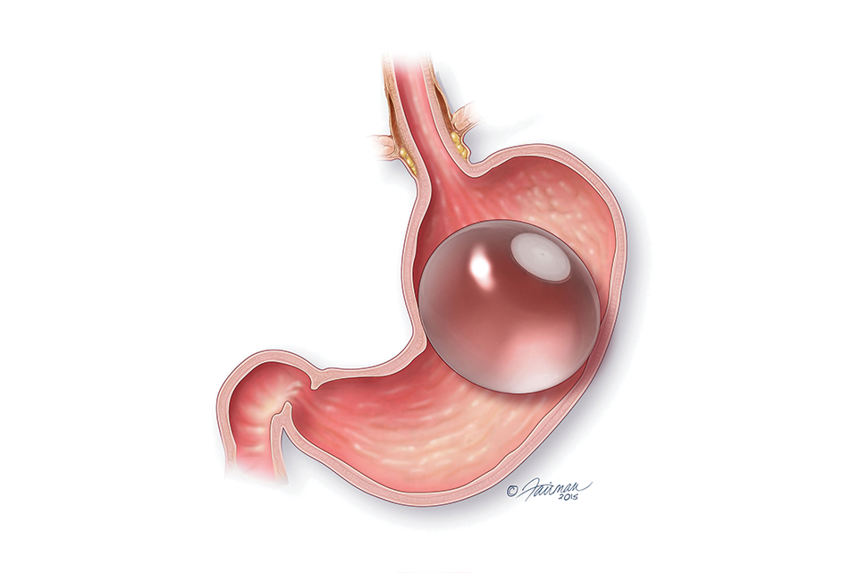 Orbera Gastric Balloon for weight loss at Birmingham Minimally Invasive