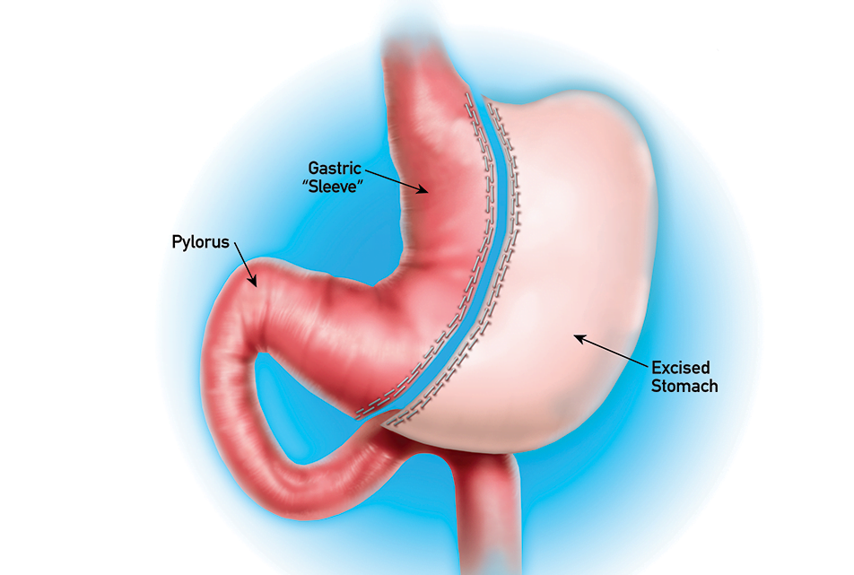 Sleeve Gastrectomy at Birmingham Minimally Invasive Surgery in Birmingham, AL