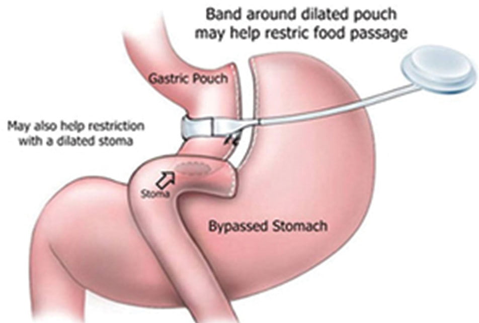 Revisional Weight Loss Surgery at Birmingham Minimally Invasive