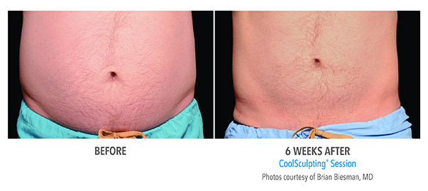 Patient of Birmingham Minimally Invasive shows weight loss results after 6 weeks of CoolSculpting.