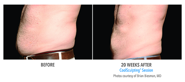 CoolSculpting leads to reduced stomach fat for this patient of BMI Surgery.