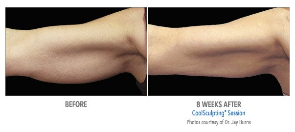 A patient of Birmingham Minimally Invasive achieves reduced fat and more toned arms after 8 weeks of CoolSculpting sessions.