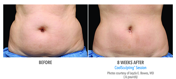 Results of reduced fat are achieved after just 8 weeks of CoolSculpting sessions at BMI Surgery in Birmingham, AL.