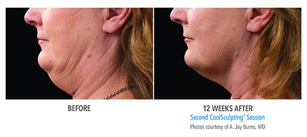 A patient of Birmingham Minimally Invasive Surgery shows her chin results from 12 weeks of CoolSculpting sessions.