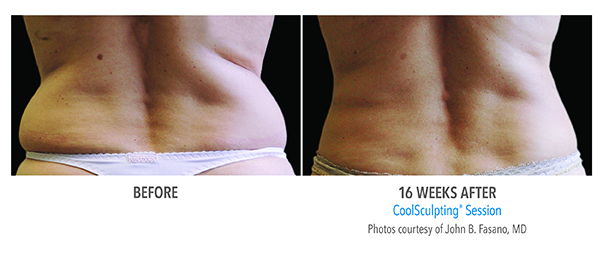 Before and after photo displays the fat reduction results of CoolSculpting performed on a patient by BMI Surgery.
