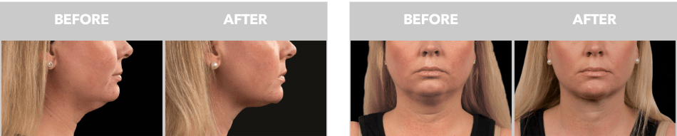 chin before and after