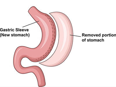 gastric sleeve stomach