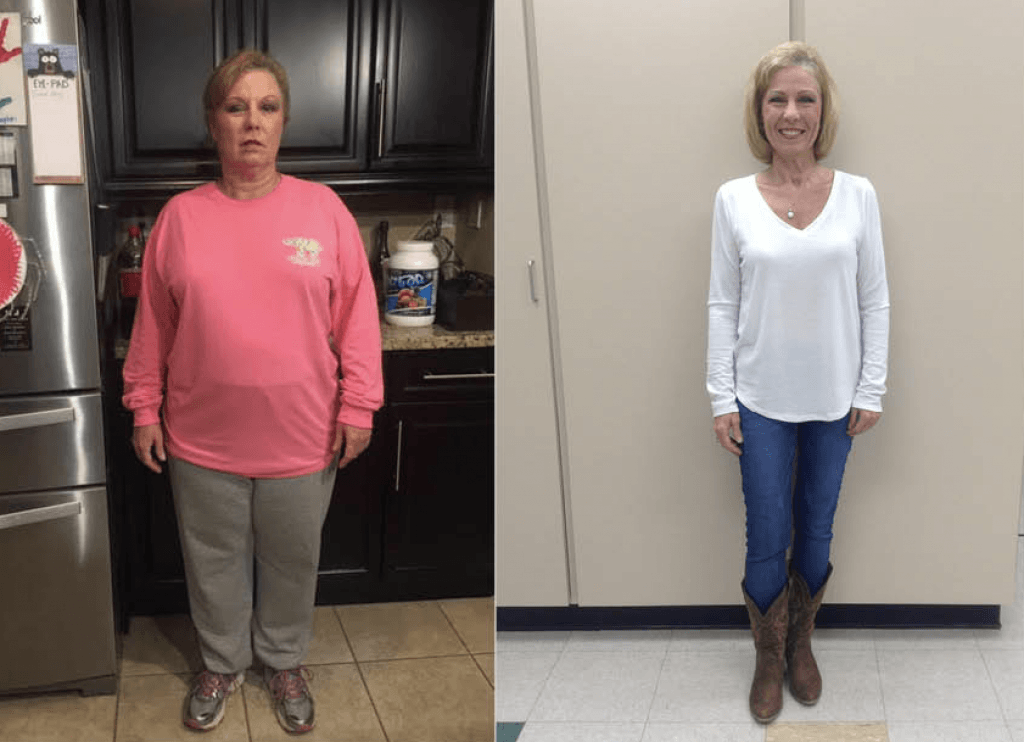 Before and After Photo of Gastric Sleeve Patient