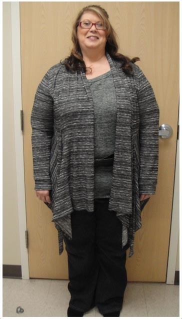 customer results before weight loss surgery