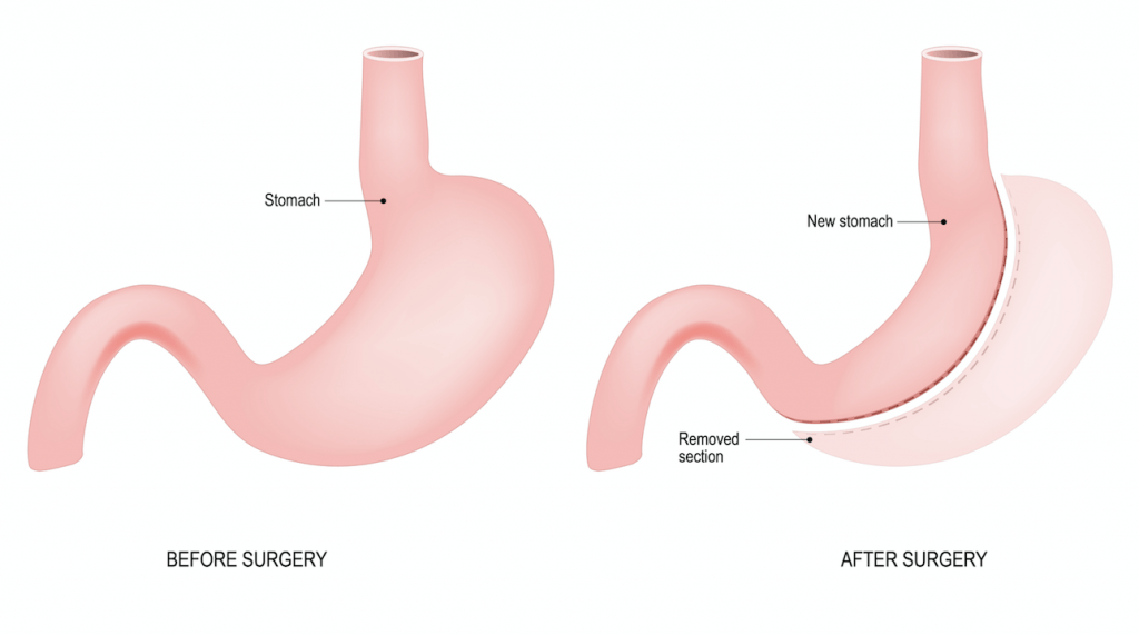 Illustration showing the size of a stomach before and after gastric sleeve surgery
