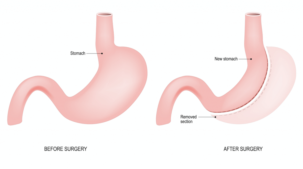 Gastric sleeve surgery: What you need to know