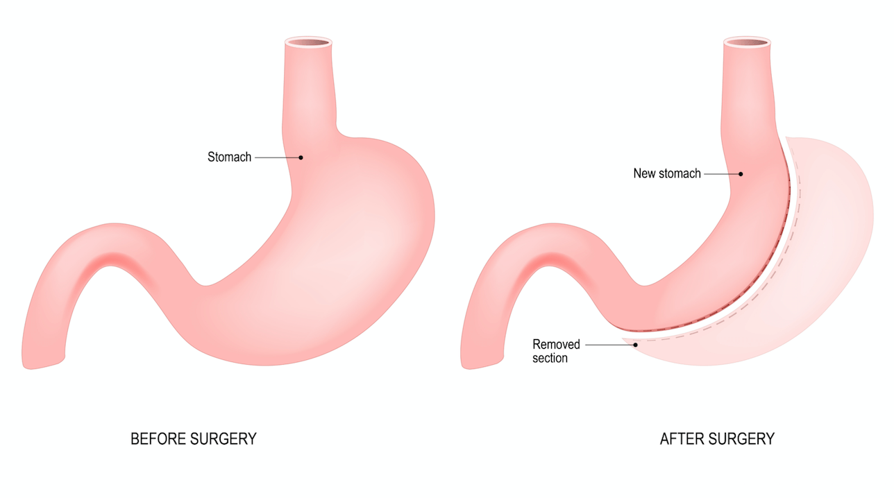 What you need to know about gastric sleeve surgery