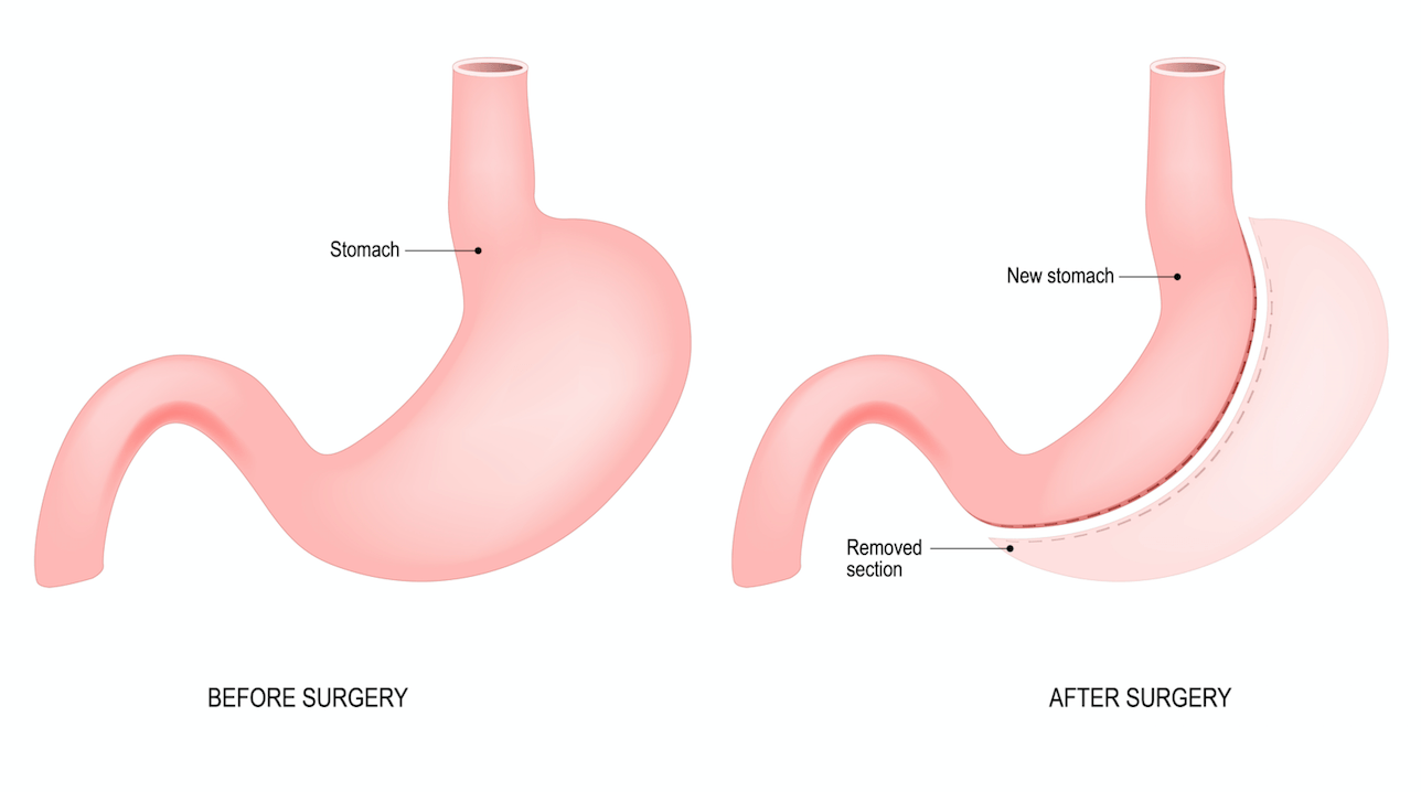 Fill 'Er Up – A Look at Gastric Banding Fills - Obesity Action Coalition