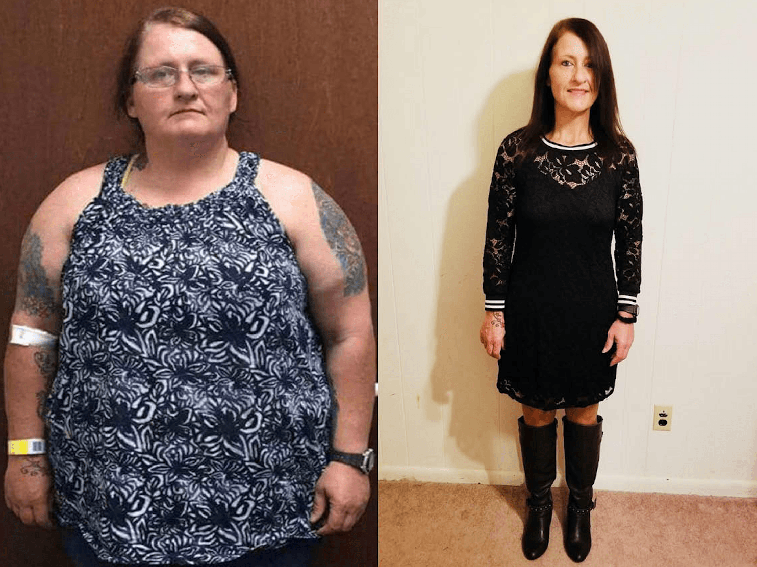 Before and after photos of gastric bypass patient