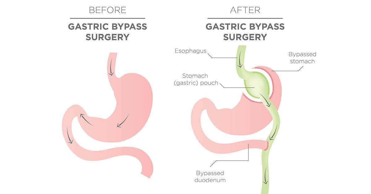 Everything you need to know about gastric bypass surgery