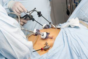 gastric bypass procedure