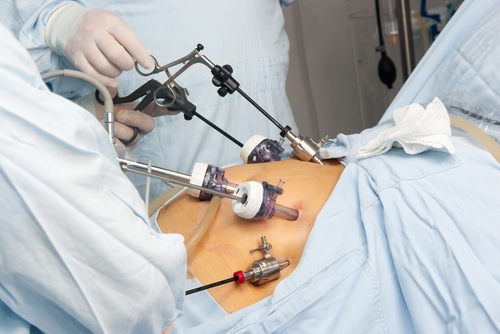 Everything you need to know about the gastric bypass procedure