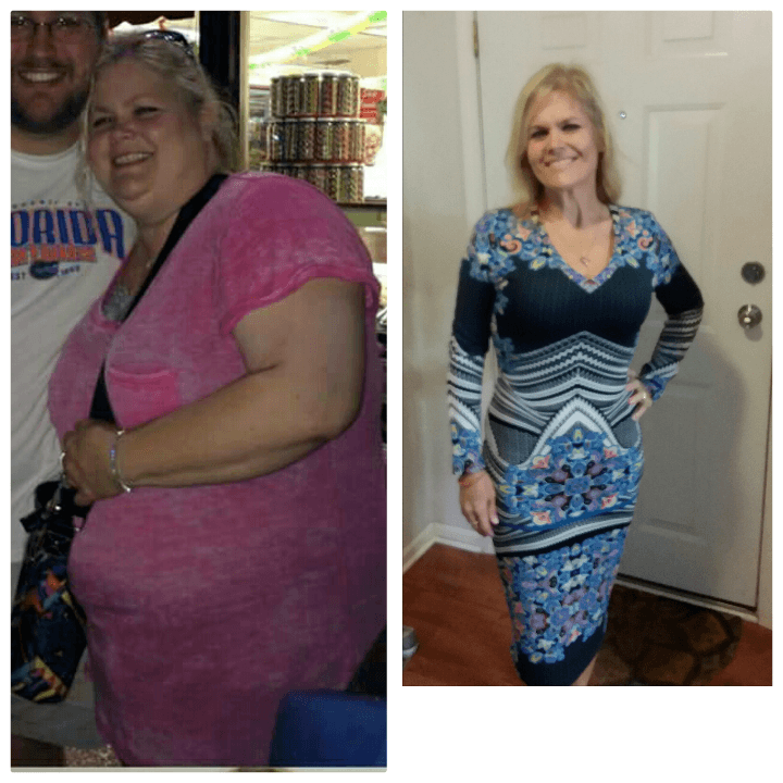 Lisa’s testimonial: gastric bypass surgery saved my life