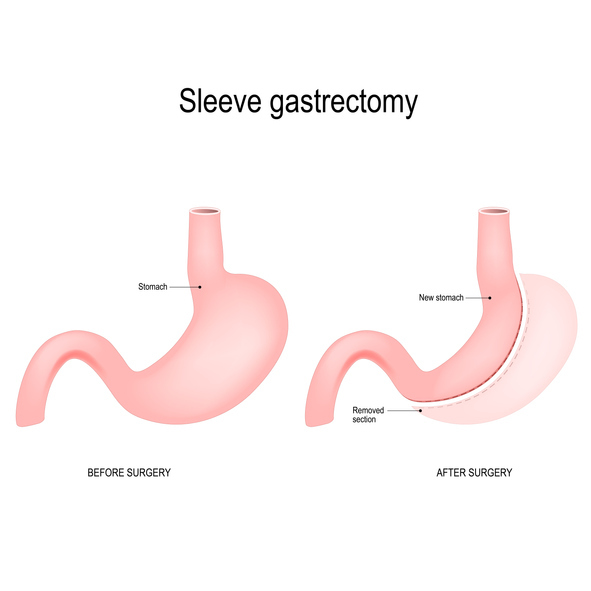 Explaining the “sleeve” in gastric sleeve surgery
