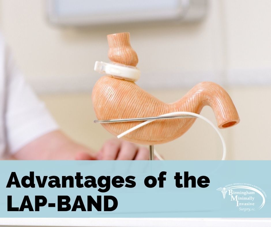 Advantages of LAP-BAND Surgery for Weight Loss