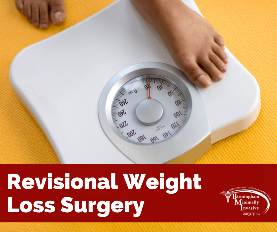 The Truth About Revisional Weight Loss Surgery