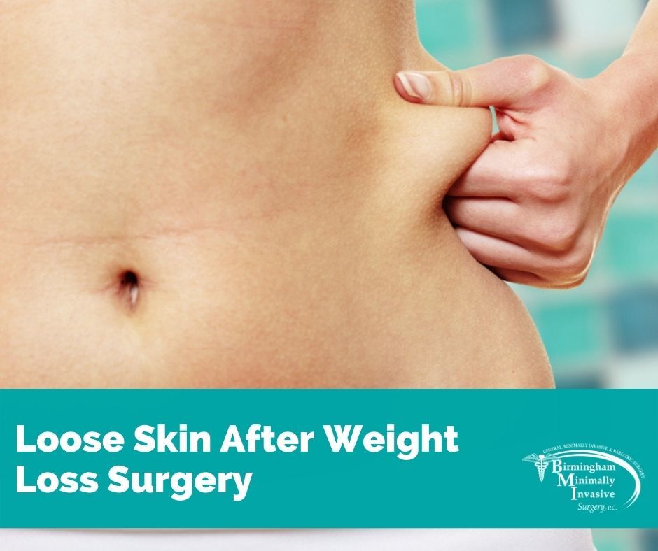 weight loss surgery loose skin