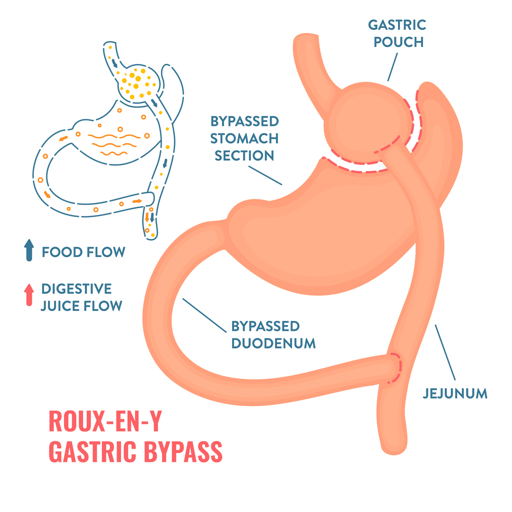 Roux-en-y gastric bypass illustration.