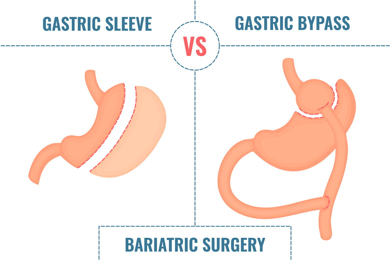 Gastric sleeve vs gastric bypass bariatric surgery weight loss infographics 